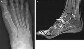 Coronal images are perpendicular to the long axis of the metatarsals. Radiologic Evaluation Of Chronic Foot Pain American Family Physician