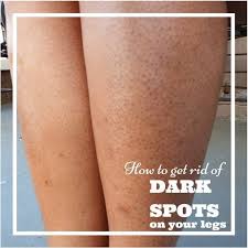 Many Women Have Dark Pores On Their Legs They Look Like A Tiny Dark Spots On Your Legs Same As Strawberry And It Dark Pores Strawberry Legs Dark Spots On Legs