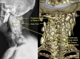 However, exercises will be prescribed to restore range of motion, and to build muscle strength in that area so that the locking won't happen again. Isolated Cervical Spine Facet Joint Tumoral Calcinosis The Spine Journal
