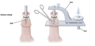 Image result for circumcision penis cut