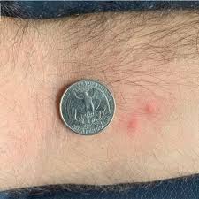 Image result for flea bite