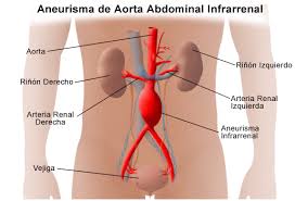 El aneurisma de la aorta es la dilatación que se produce en esta arteria, a través de la cual fluye y se generalmente, un aneurisma se produce donde se encuentren paredes debilitadas de la aorta. Aneurisma De Aorta Abdominal Download Scientific Diagram