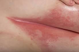 Image result for Candidiasis under breasts