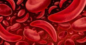 Optimizing Opioid Prescribing for Chronic Pain in Sickle Cell Disease