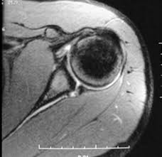 Learn vocabulary, terms and more with flashcards, games and other study tools. Posterior Labral Tear Shoulder Elbow Orthobullets