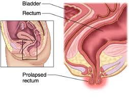 Image result for Rectal Prolapse