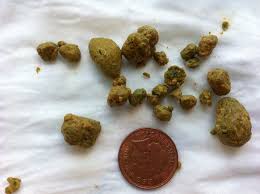 Liver Gallbladder Stones Are The Root Cause Of Most Diseases In The Body Rid Your Liver And Gallbladder Gallbladder Stones Healthy Happy Health And Wellness