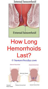 Thrombosed hemorrhoids are not considered to be. What Causes Thrombosed External Hemorrhoid How Can I Treat External Hemorrhoids How To Avoid Get With Images Getting Rid Of Hemorrhoids Hemorrhoids Hemorrhoids Treatment