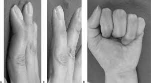 For simple closed mallet ﬁnger injuries, surgery is controversial. The Thompson Procedure For Chronic Mallet Finger Deformity Sciencedirect