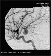 An aneurysm is an outward bulging, likened to a bubble or balloon, caused by a localized, abnormal, weak spot on a blood vessel wall. Aneurisma Definition Und Synonyme Von Aneurisma Im Worterbuch Italienisch