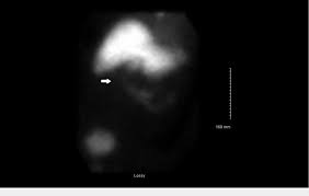 Hepatobiliary Iminodiacetic Acid Hida Scan The Arrow Indicates The Download Scientific Diagram