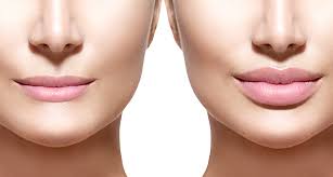 как убрать гиалуроновую кислоту из губ в домашних условиях Kogda Spadaet Otechnost Posle Uvelicheniya Gub