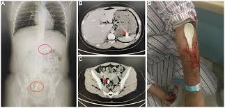 Image result for Pica