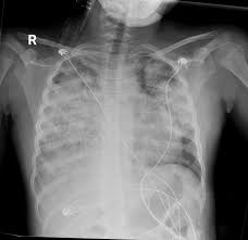 Image result for Microscopic Polyangiitis