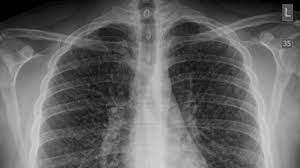 Medicos Relatam Primeiro Caso De Pulmao De Pipoca Relacionado A Cigarros Eletronicos Gizmodo Brasil
