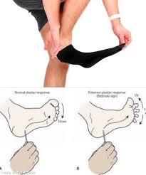 Image result for Babinski Reflex