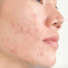 When done too often, it can cause redness, inflammation, and irritation. 6 Adult Acne Causes And How To Get Rid Of It Say Dermatologists