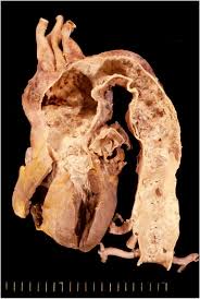 Image result for Cardiovascular Syphilis