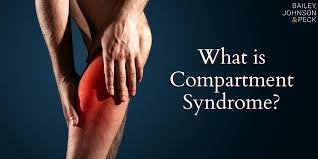 Image result for Compartment Syndrome