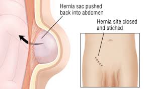 inguinal hernia harvard health