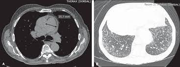 Scielo Brasil Tomography Patterns Of Lung Disease In Systemic Sclerosis Tomography Patterns Of Lung Disease In Systemic Sclerosis