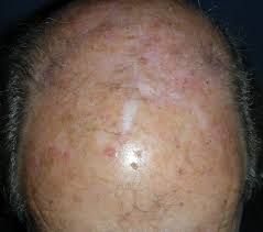 If you have skin cancer, it is important to know which type you have because it affects your treatment options and your outlook (prognosis). Skin Cancer Scalp With Local Flap Repair Dr Damian Marucci Cosmetic Plastic Reconstructive Surgeon