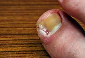 You can try adding a quarter cup of vinegar to warm water for a foot soak or direct application of apple cider vinegar that has been diluted with purified water, which conditions ingrown nails to fight bacteria that may try to form. The Stages Of An Infected Ingrown Toenail Advanced Tissue