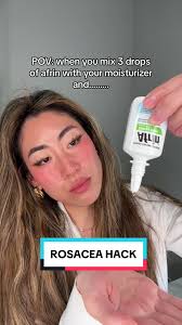 Effective Skincare Hacks for Rosacea Relief