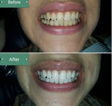 Find meaningful content for braces at home. Simple Ways To Get Natural White Teeth Natural Teeth Whitening