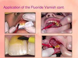 Fluoride Varnish