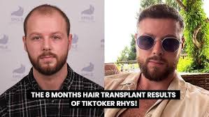 Hair Transplant Network Podcast #5 Dr. Mwamba- Live Q&A, Hairline Repairs,  and Topical Finasteride