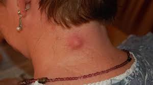 Image result for Cyst