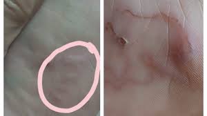 Banyak wanita yang bingung bagaimana cara mengatasi keputihan yang tepat. Seorang Wanita Alami Infeksi Cacing Di Kaki Setelah Liburan Ini Sebabnya