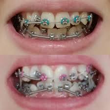 I wore braces for a few years. 4 Months Progress Day One On The Bottom And Last Week On The Top Braces