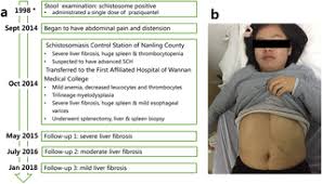 No symptoms in some cases pain or fullness in the left upper abdomen that may spread to the left shoulder feeling full without eating or after eating only a small amount from the enlarged spleen pressing on your stomach Reversal Of Liver Fibrosis After Splenectomy In A Patient With Advanced Schistosomiasis Japonica A Case Report With 4 Year Follow Up