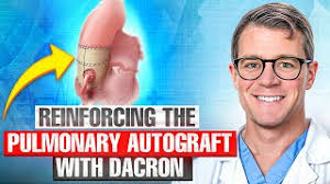 Reinforcing the Autograft with Dacron During Ross Procedure