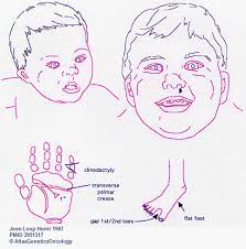 Trisomy 21