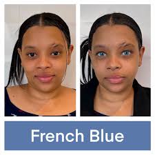 keratopigmentation #keratonyc #keratomiami #safeeyecolorchange  #kerato_nyc_safe_eye_color_change #doctormovshovich #kerato #eye  #eyecolorchange #keratopigmentação #beauty #permanenteyecolorchange  #cosmeticsurgery #beforeandafter #eyejob #neweyes ...