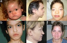 Bicknell, LS et al. 1 A molecular and clinical study of larsen syndrome  caused by mutations in FLNB Louise S Bicknell , Clair
