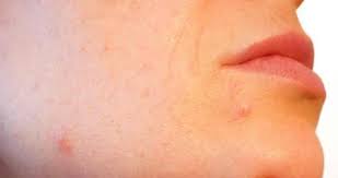 deri alti kor sivilceler nasil gecer yuzde cikan sivilce gibi sislik neden olur saglik haberleri