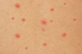 Risk factors for chicken pox include lacking immunity either through vaccination or previously contracting the disease and being in contact with an. What Does Chickenpox Look Like New Health Advisor
