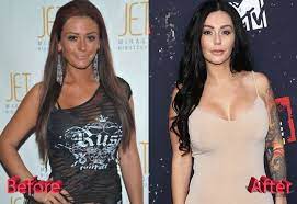 The number of people getting cosmetic procedures has risen steadily over the past five years and there are several reasons why. Jwoww Plastic Surgery Thumbs Up Or Thumbs Down