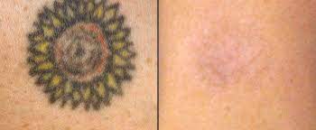 It's fast, reasonably priced, virtually painless, and the. Athens Ga Tattoo Removal Yuva Medical Spa
