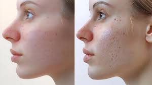 Antes y despu&eacute;s mascarilla mineral