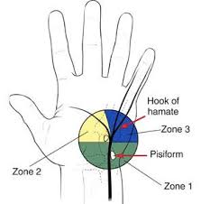 The bullseye wrist band was designed to provide 360° support and targeted compression around the ulnar head, without putting painful pressure on the ulnar head. Ulnar Tunnel Syndrome Of The Wrist Orthoinfo Aaos