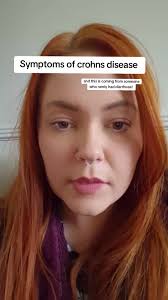 Gaynor Elissa Goldie Crohns