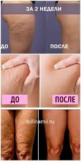 как убрать апельсиновую корку на лице в домашних условиях Cellyulit Ischeznet Volshebnym Obrazom Drevnee Proverennoe Sredstvo Cellyulit Na Nogah Cellyulit Zdorove