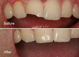 Composite Fillings In New Delhi White Tooth Coloured Fillings Dental Composite Resin Teeth Fillings In Del Tooth Filling Chipped Tooth Repair Chipped Tooth