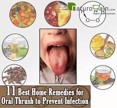 11 Best Home Remedies For Oral Thrush To Prevent Infection Home Remedies Oral Thrush Remedies Home Remedies For Thrush