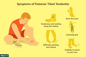 Proach is based partly on surgeon preference and. Posterior Tibial Tendonitis Signs And Treatment